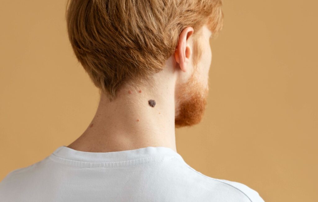 Melanoma, câncer de pele mais agressivo, pode surgir a partir de uma simples pinta
