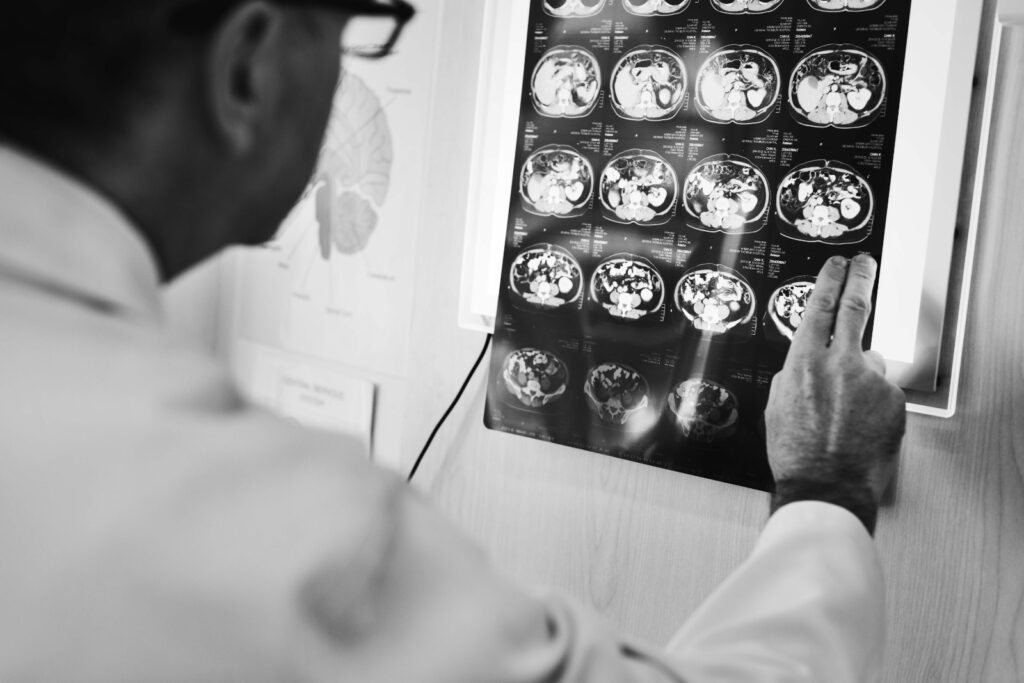 Tumores cerebrais podem atingir todas as idades e têm na radioterapia uma importante aliada no tratamento